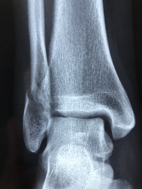 Peoria Personal Injury